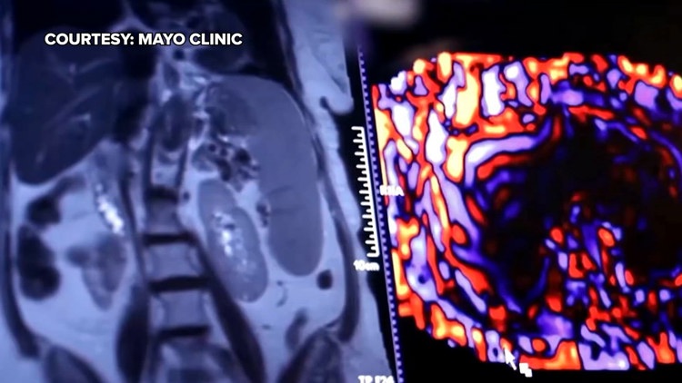 Healthy SA: Battling liver cancer, a disease which often has no symptoms early on — KENS 5 (San Antonio), San Francisco Health news