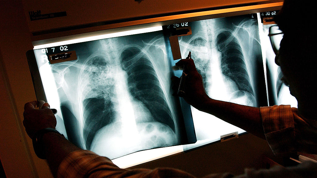 2 active tuberculosis cases traced to San Francisco strip club — KTVU FOX 2 Bay Area